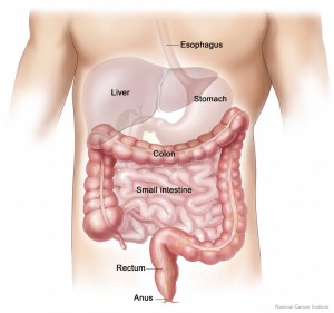 colon cancer