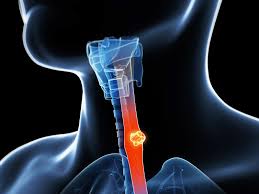 esophageal cancer prevention los angeles